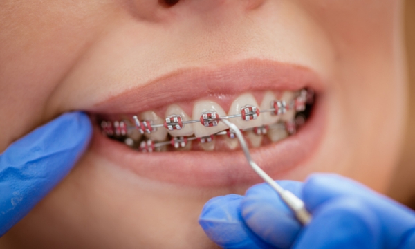 W jakich przypadkach można stosować ruchome aparaty na zęby?